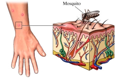 http://www.mosquitoweb.it/generale/curare-le-punture-di-zanzara.html